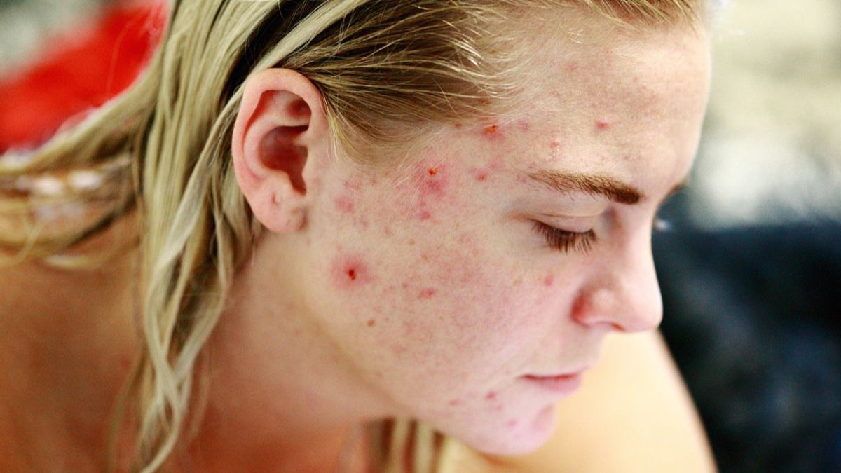 Bahaya Menggunakan Acne Patch Terlalu Lama, Bisa Sebabkan Iritasi