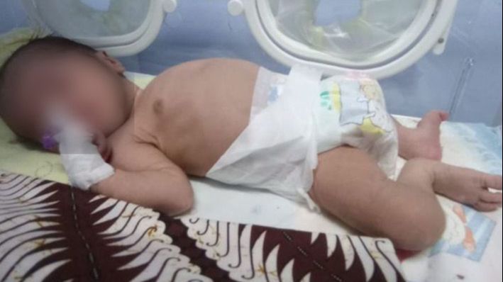 Kisah Pilu Bayi Baru Lahir Ditinggal Kabur Ayah, Sel Tubuhnya Digerogoti Bakteri Ganas Harus Dirawat di ICU