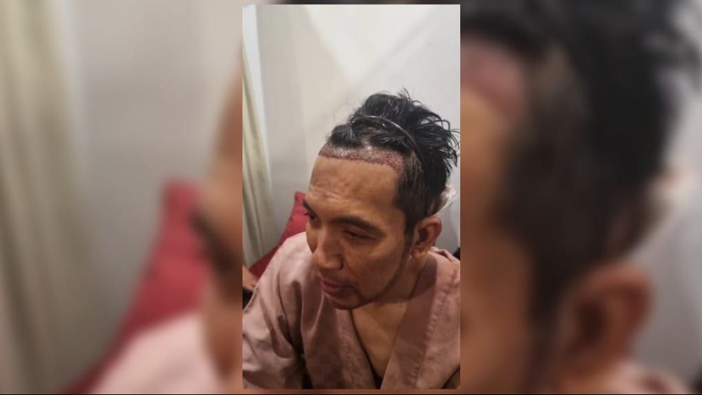 Deretan Artis Tanah Air Jalani Transplantasi Rambut, Terbaru Ada Desta yang Penampilannya Bikin Pangling