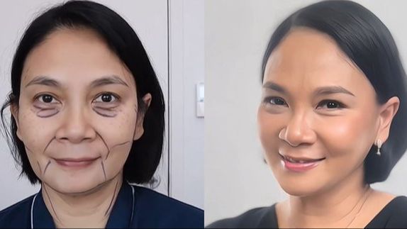 Potret Terbaru Dian Nitami Usai Sebulan Operasi Face Lifting, Hasilnya Natural Jadi Lebih Cantik & Awet Muda