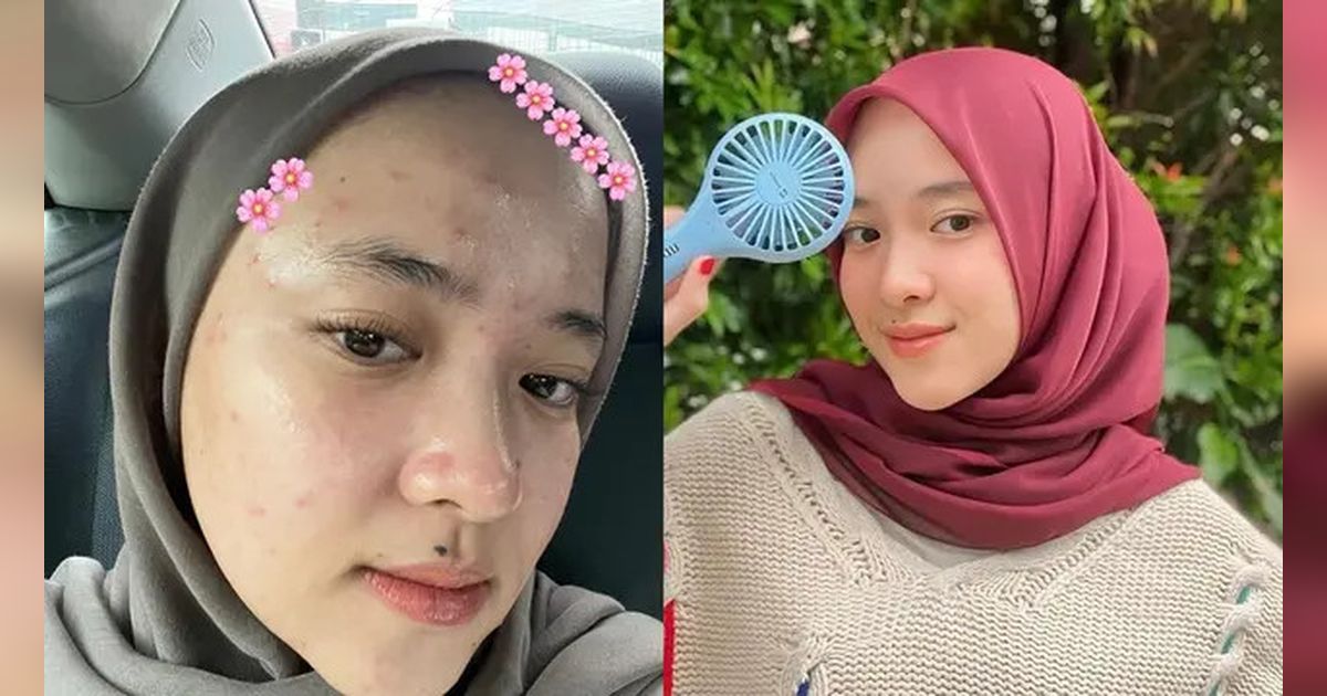 Potret Nissa Sabyan Percaya Diri Tampilkan Wajah Berjerawat Tanpa Makeup, Bikin Pangling