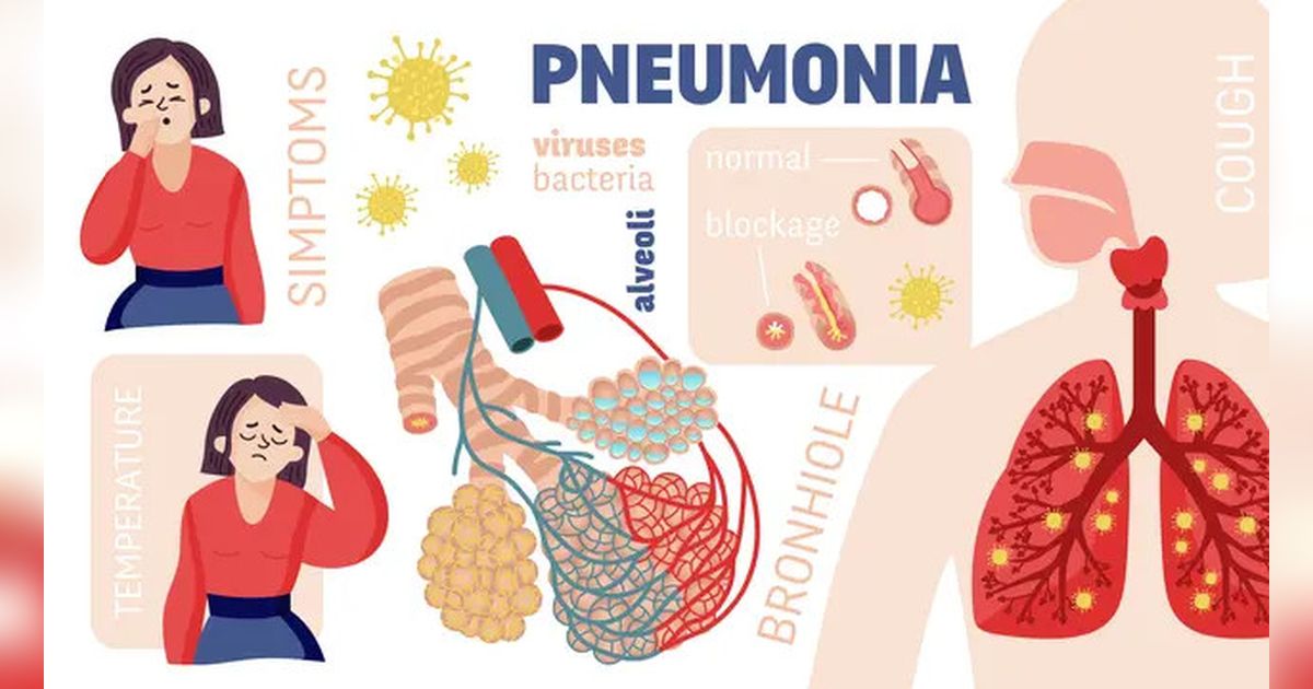 Perbedaan antara Bronkopneumonia dan Pneumonia yang Perlu Kita Ketahui