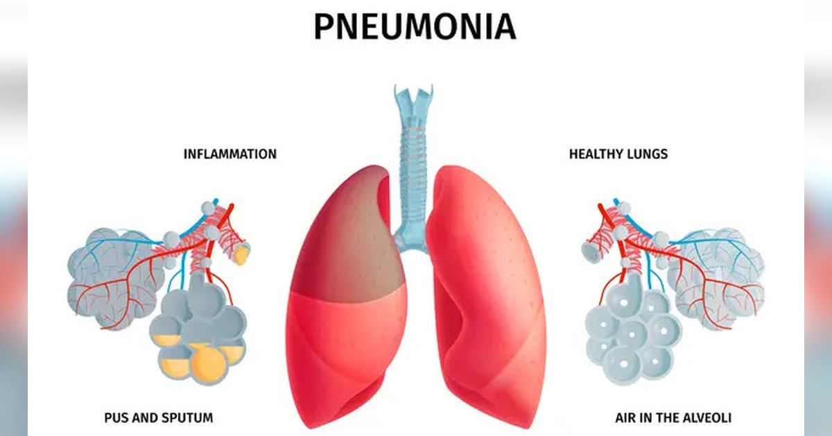 Lima Langkan Cegah Peradanngan Paru-paru Akibat Pneumonia