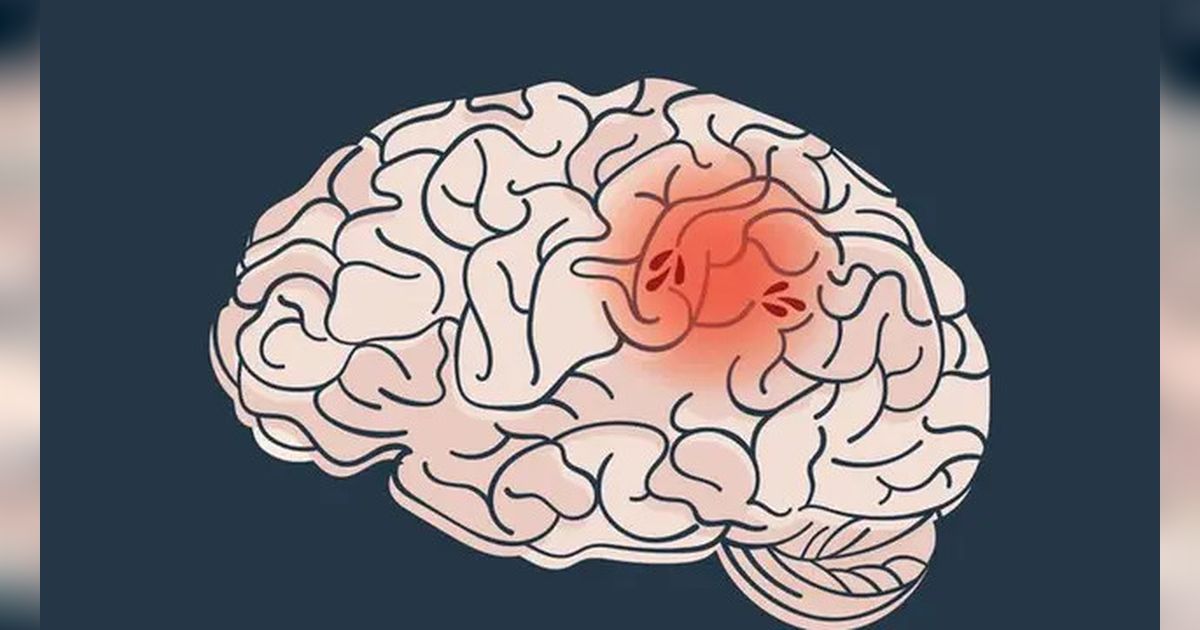 5 Metode Efektif untuk Menurunkan Risiko Stroke melalui Pola Hidup Sehat