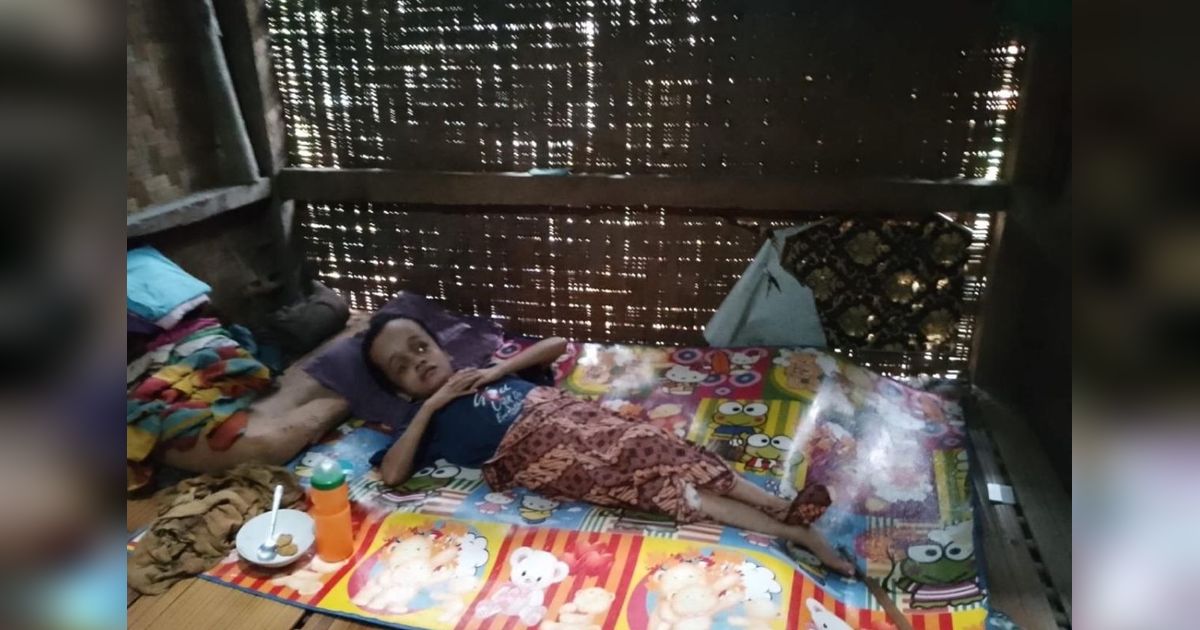 Ani, Gadis Penderita Hidrosefalus Butuh Bantuan Donatur