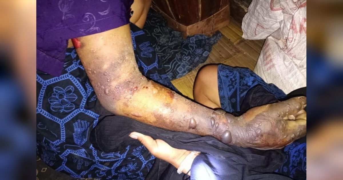 Relawan Selamatkan Warga Badui Korban Gigitan Ular Tanah Berbisa
