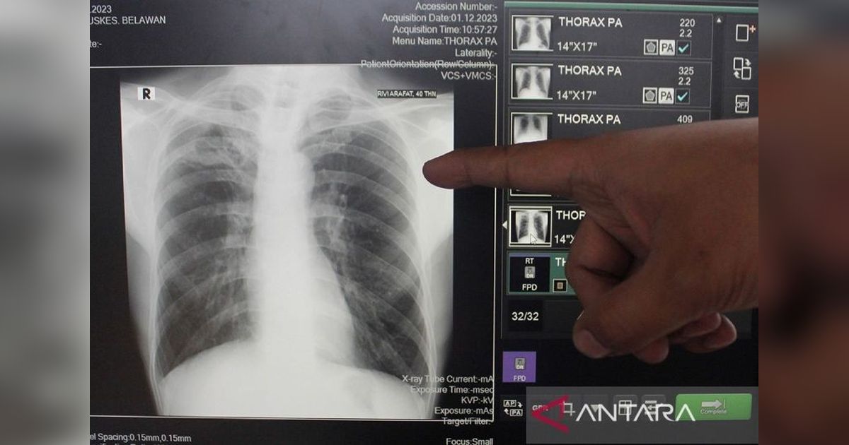 Kemenkes Laporkan 856.420 Kasus TBC di Tahun 2024