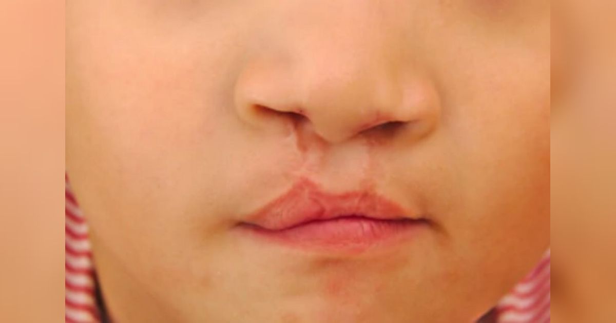Deteksi Bibir Sumbing Sejak dalam Kandungan Kini Dimungkinkan Lewat USG