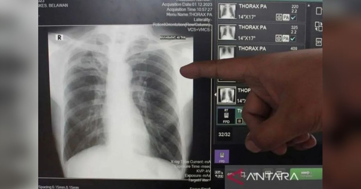 Pemkot Bandarlampung: Kepatuhan Minum Obat, Kunci Sembuh dari TBC