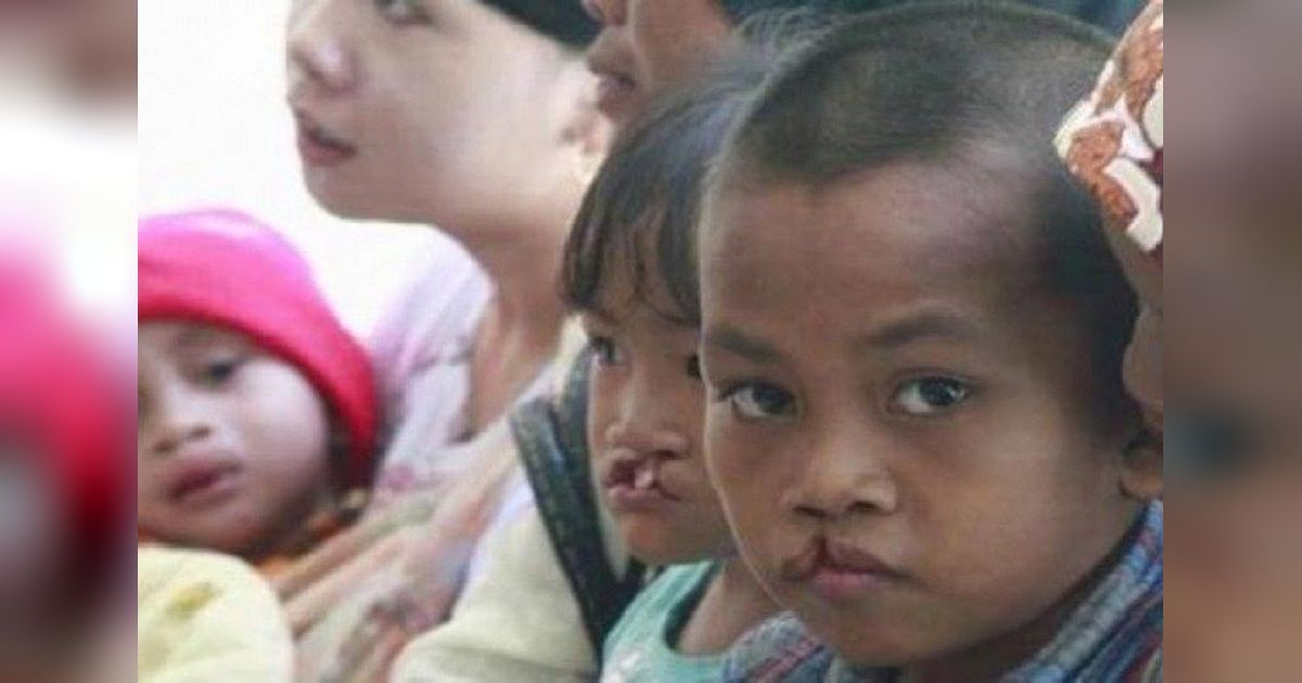 Bibir Sumbing dan Celah Langit: Gangguan Perkembangan yang Perlu Perhatian Serius
