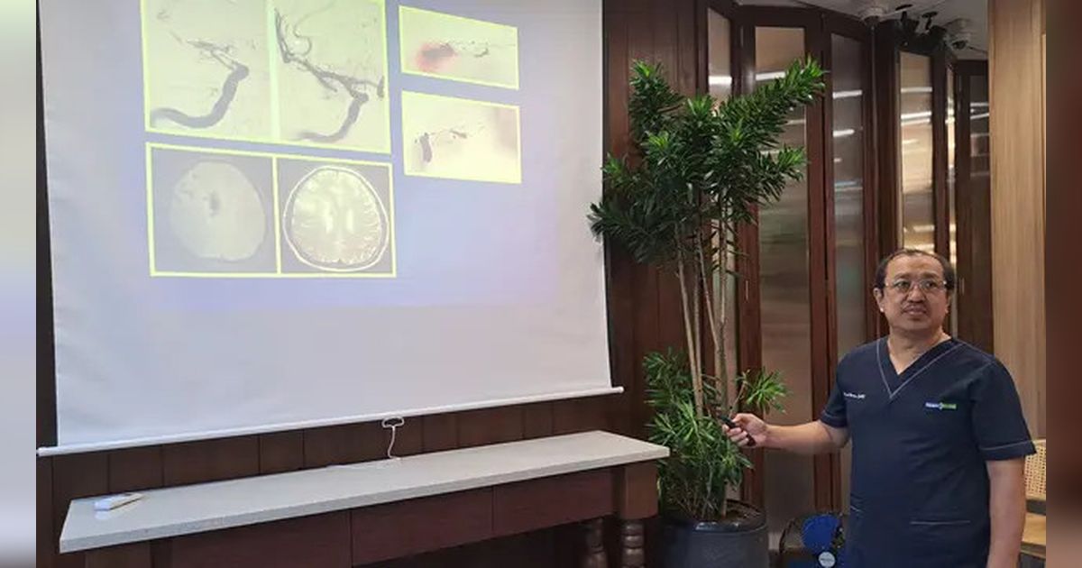 Sering Sakit Kepala Tiba-Tiba? Jangan Diremehkan Bisa Jadi Gejala Stroke Ringan