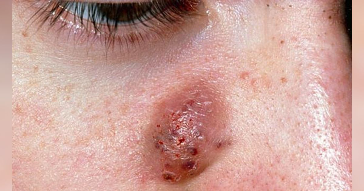 4 Jenis Jerawat Paling Bandel dan Cara Ampuh Mengatasinya Tanpa Bikin Kulit Iritasi