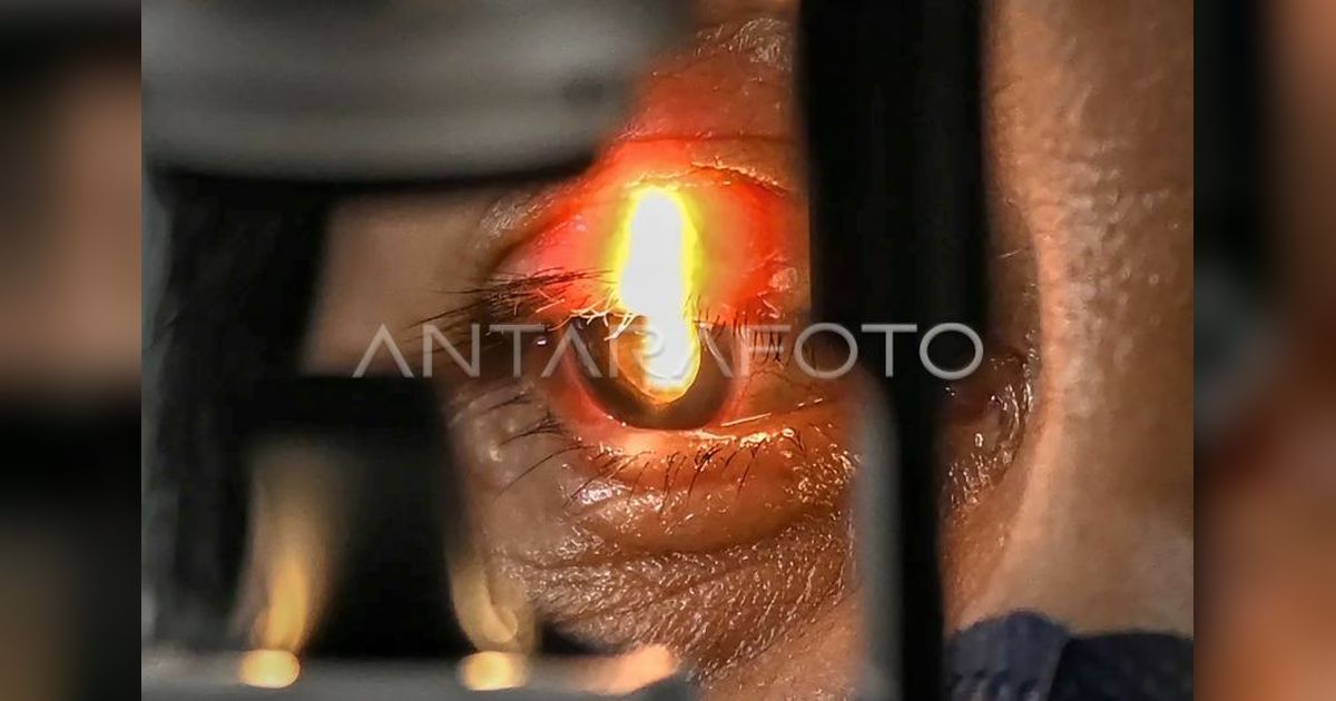 Pemkot Jakbar Gelar Operasi Katarak Gratis, Targetkan Ratusan Warga