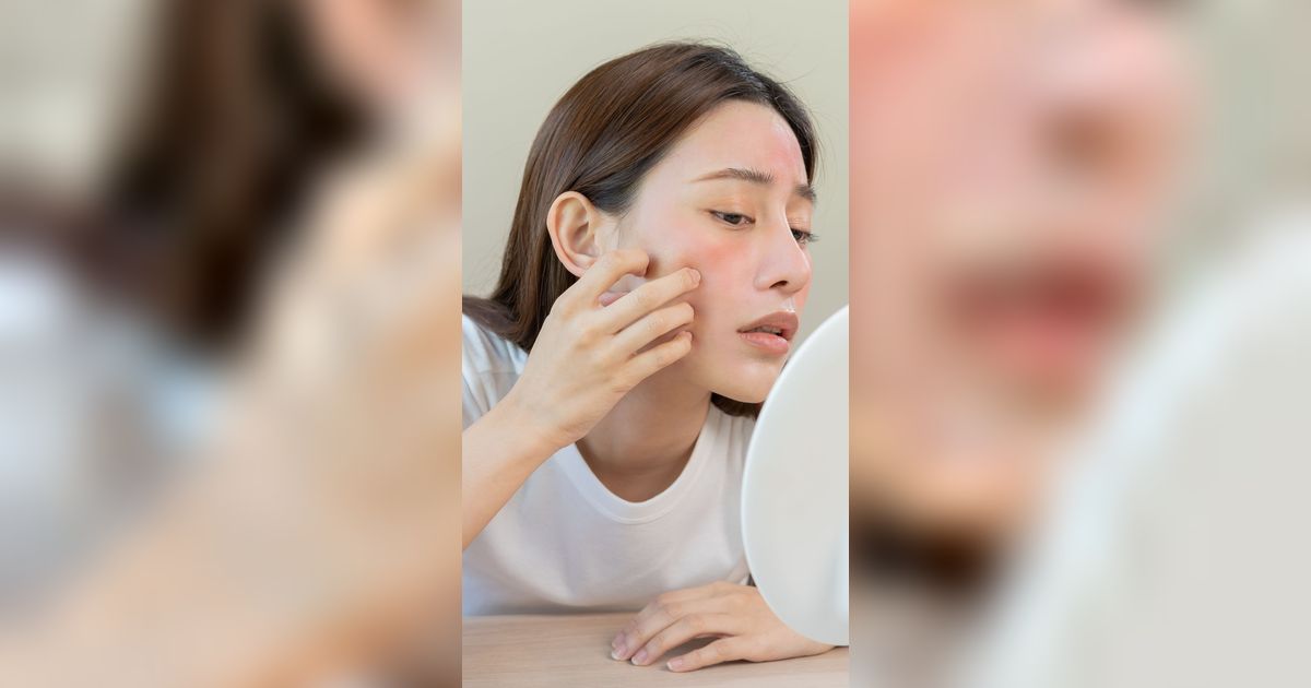 Kulit Wajah Iritasi Sampai Merah, Jangan Langsung Ditutup Makeup