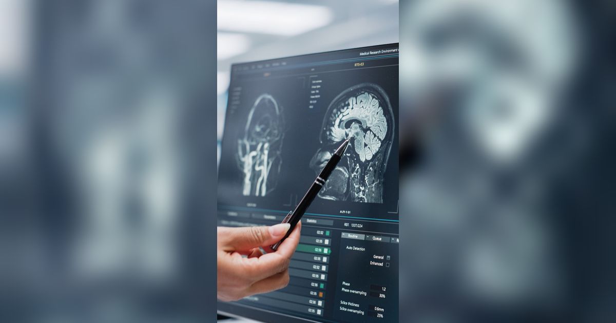 CT Scan Penggila Kopi dan Bergadang Bikin Takut Warganet, Usia 30 Pendarahan Otak