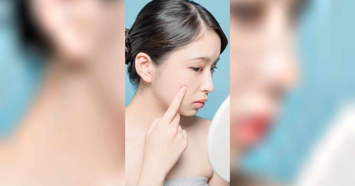 Konsentrasi Ideal Salicylic Acid untuk Hempas Jerawat