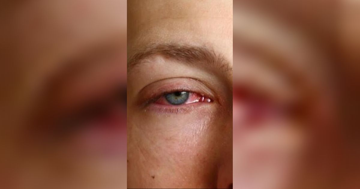 Heboh Virus Mata Berdarah Telah Menyebar di Eropa, Belum Ada Obatnya