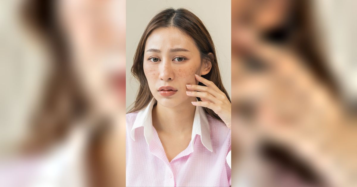 Jangan Dipencet, Lakukan Step Bersihkan Jerawat yang Aman