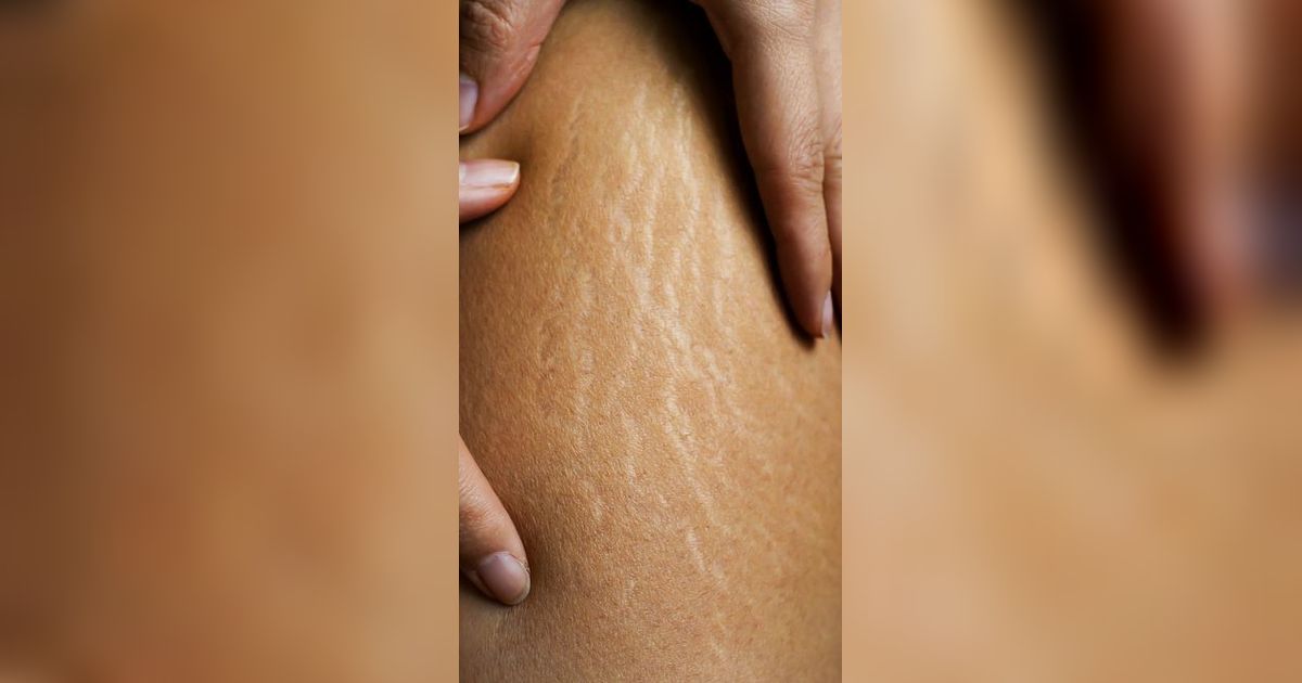 Sering Jadi Kekhawatiran Banyak Orang, Stretch Marks Ternyata Bisa Disamarkan dengan Perawatan Dalam Lho