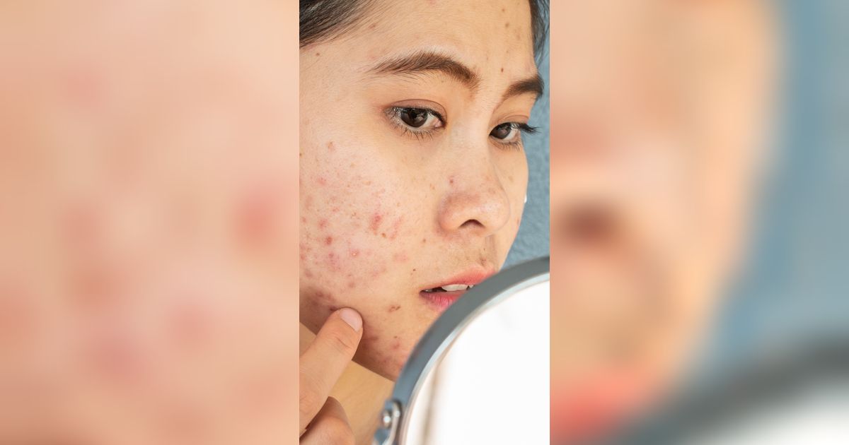 Kulit Bopeng Tak Mempan Hanya Pakai Skincare Biasa,  Dokter Beri Penjelasan