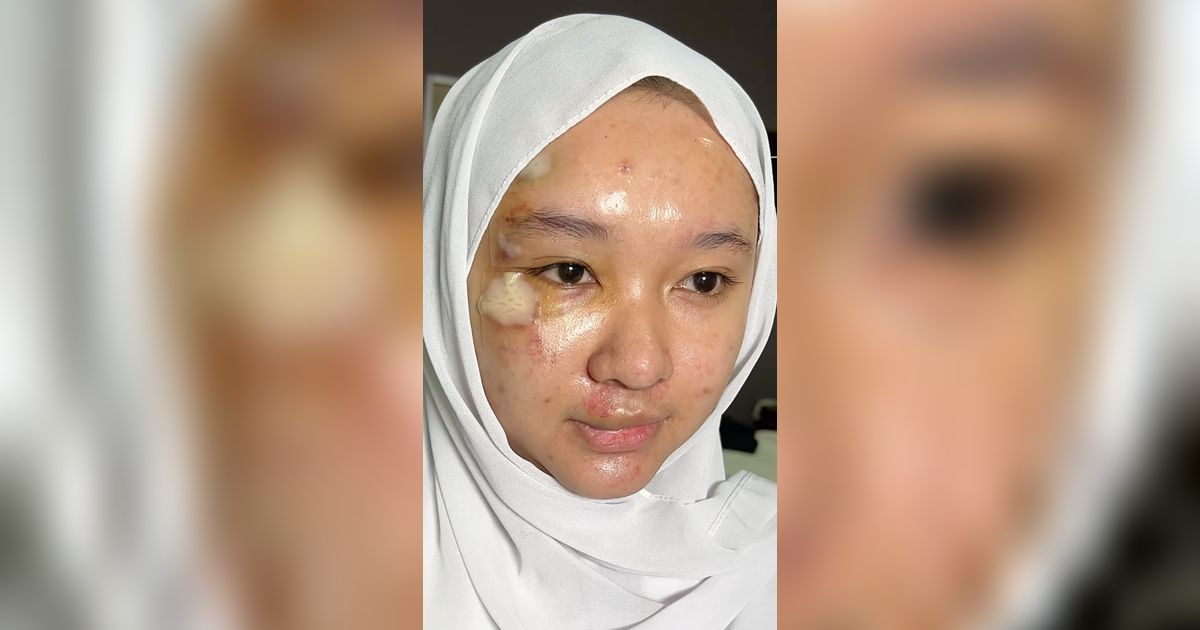 Wajah Pengantin Terluka Akibat Kecelakaan Jelang Pernikahan, Hasil Riasan MUA Bikin Takjub