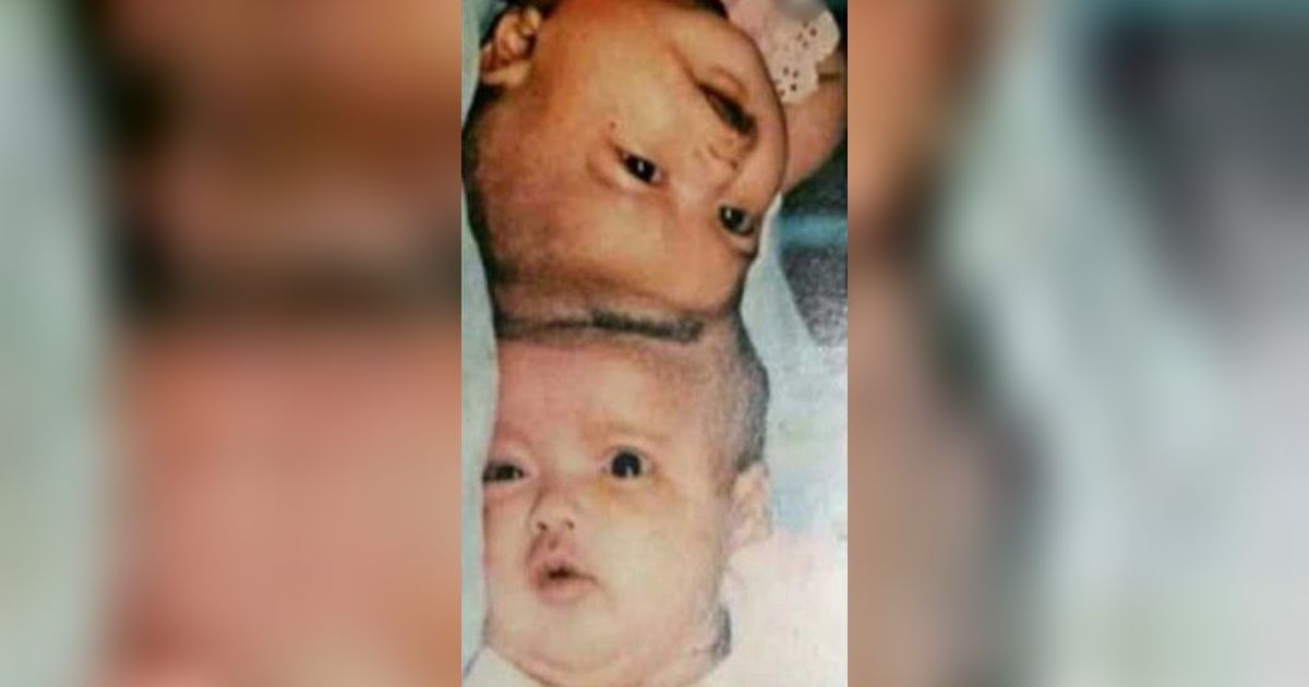 Ingat Yuliana-Yuliani, Kembar Siang Dempet Kepala yang Berhasil Dioperasi? Nasibnya Kini 