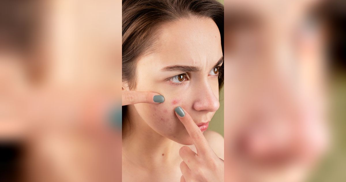 Kulit Kemerahan Akibat Jerawat?  Coba 6 Cara untuk Meredakannya