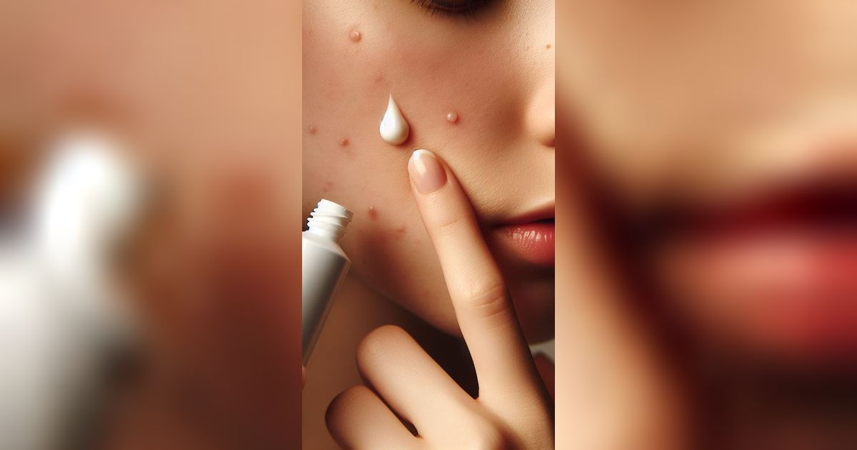 7 Rekomendasi Acne Spot Gel Murah Meriah untuk Sembuhkan Jerawat, Tak Sampai Rp50.000