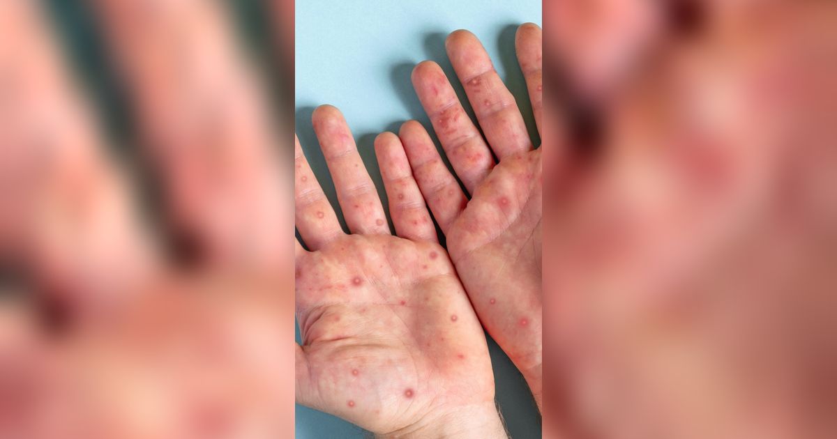 Viral Curhat Ibu yang Balitanya Alami Ruam Parah Setelah Mandi Bola