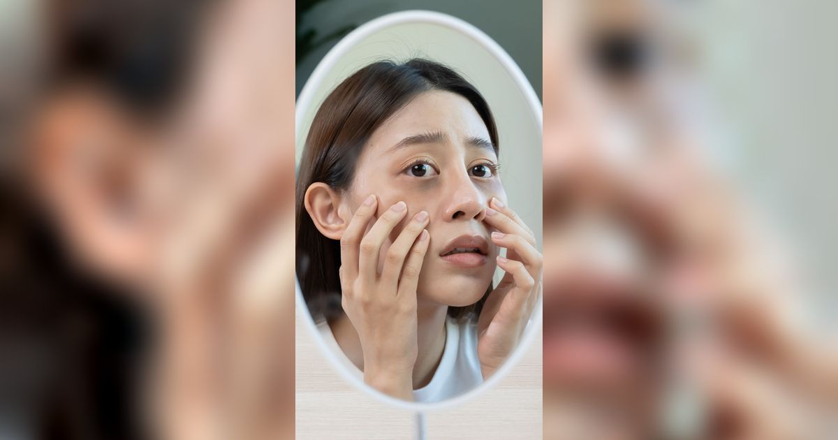 Lakukan Pinch Test ala Dokter, Biar Tahu Solusi Mata Panda yang Tepat
