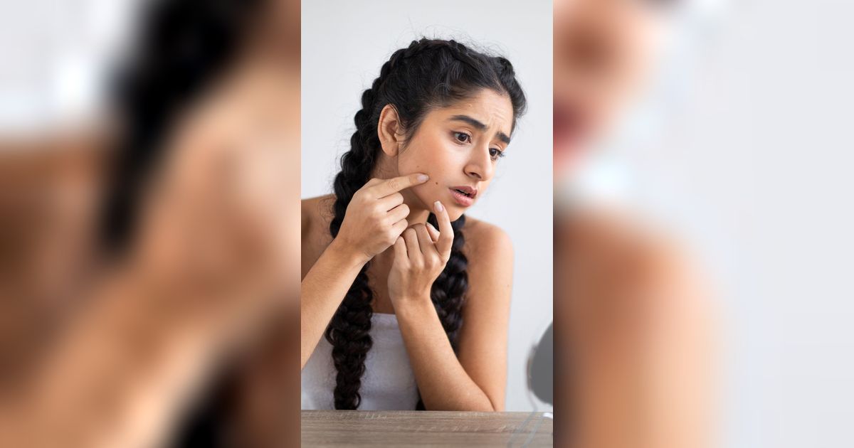 Bintik Komedo Kecil Jangan Diabaikan, Atasi Segera dengan Bahan Rumahan