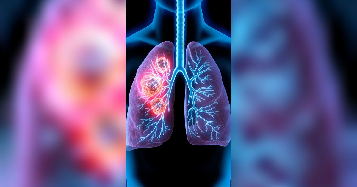 Kebiasaan Pemicu Kanker Paru-paru, Cegah Sejak Dini