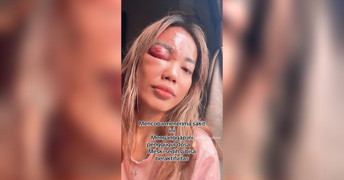 Posting Foto Liburan Berujung Petaka, Wanita Ini Terkena Ain Karena Dipuji Cantik, Matanya Langsung Bengkak