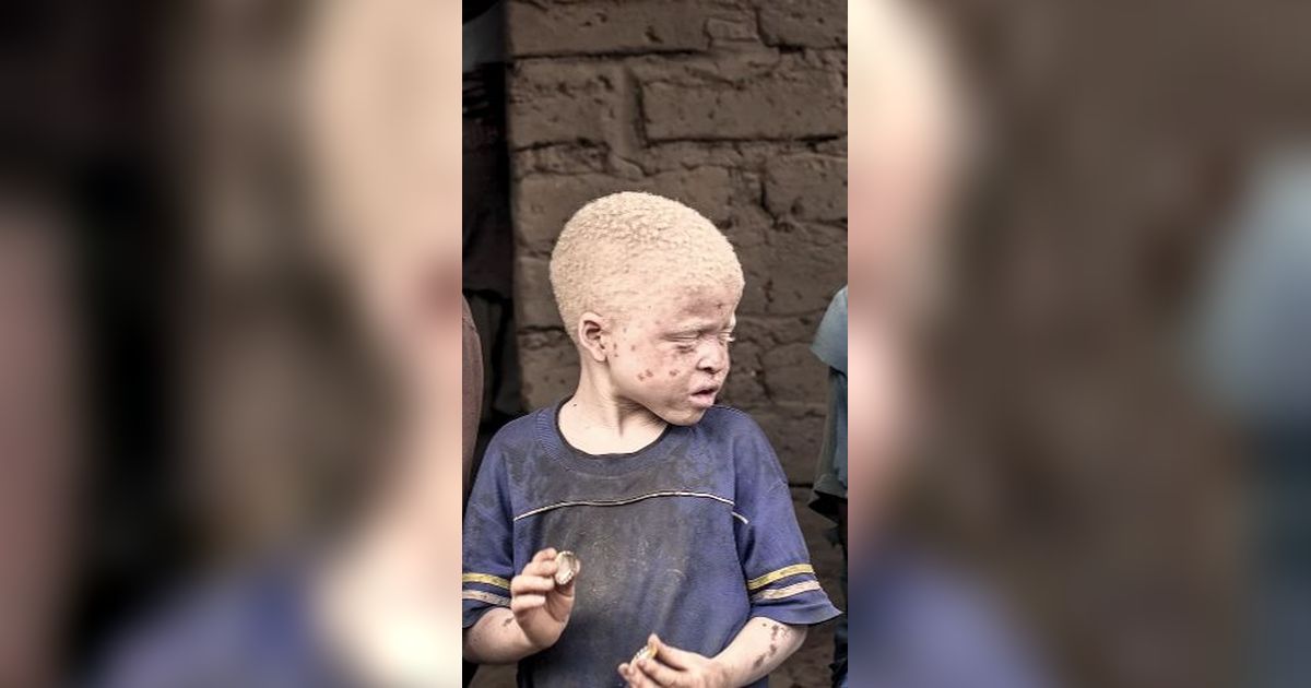 Potret Kampung Albino Tersembunyi di Tanzania, Begini Kondisinya