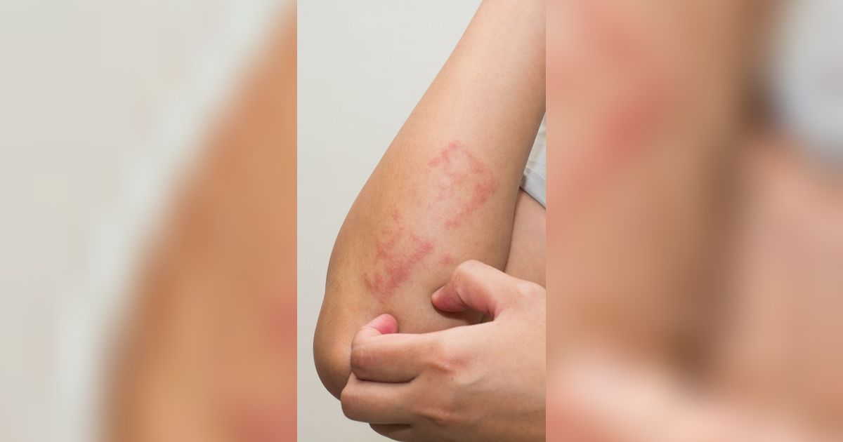 Penyebab Dermatitis Seboroik Beserta Gejala dan Cara Mengobatinya