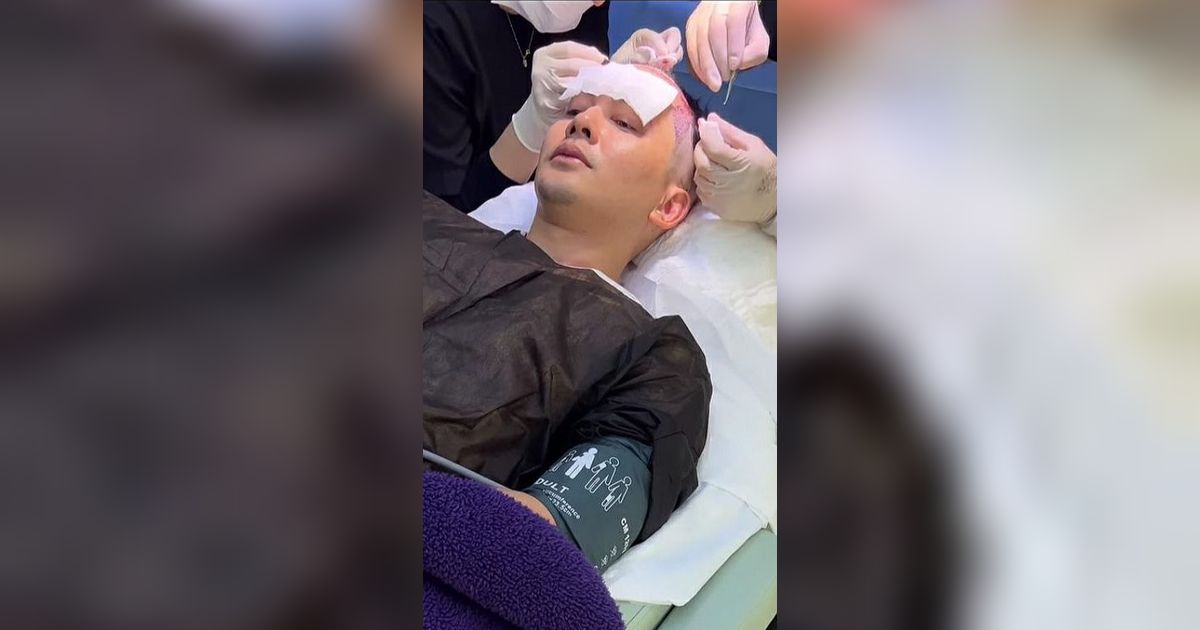 Potret Kiki Farrel Operasi Transplantasi Rambut di Turki, Habis Berapa Duit?