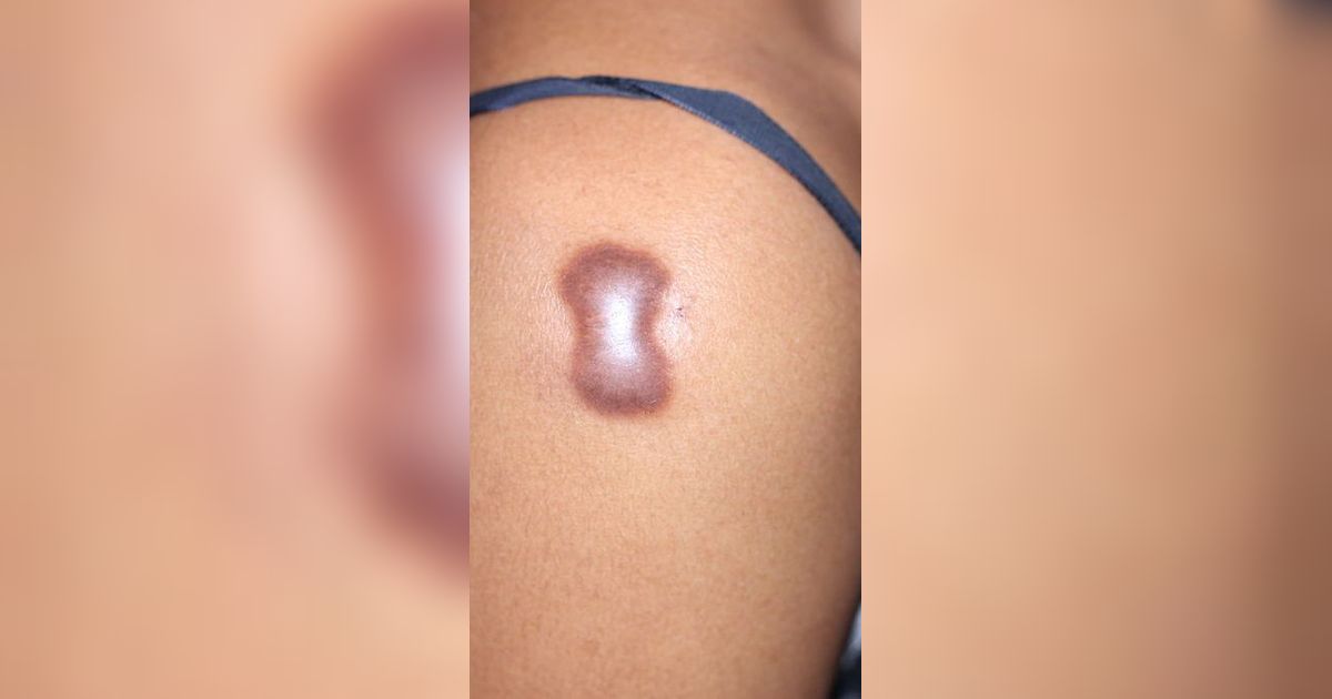 10 Cara Mudah dan Praktis Mencegah Luka Berubah Menjadi Keloid