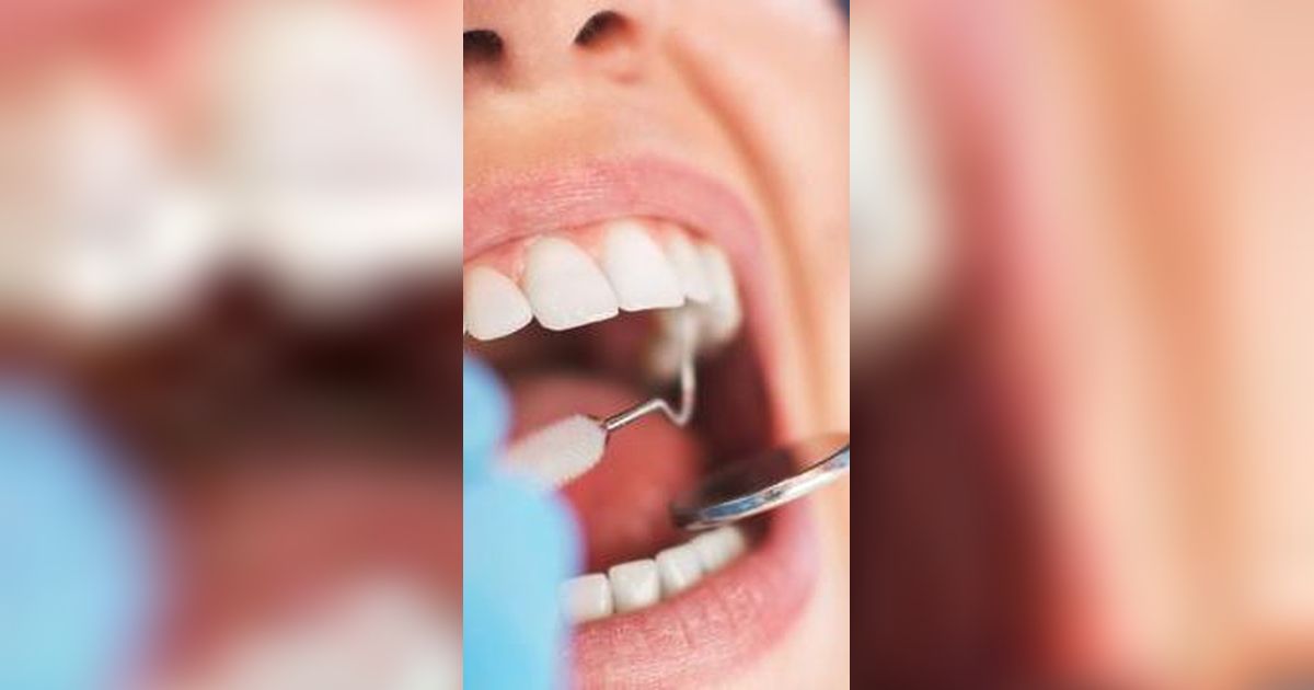 Cara Menghilangkan Karang Gigi yang Tepat dan Mudah Dilakukan Sendiri di Rumah