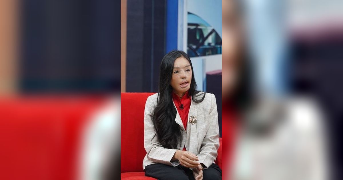 Pernah Jadi Korban KDRT Penyiraman Air Keras, Begini Kabar Terbaru Lisa ‘Face Off’