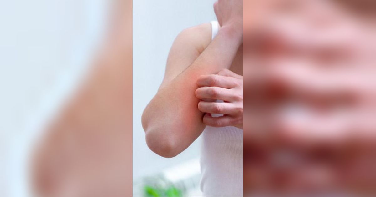 Gejala Psoriasis Vulgaris, Gangguan Autoimun Lesi Merah dan Bercak pada Kulit