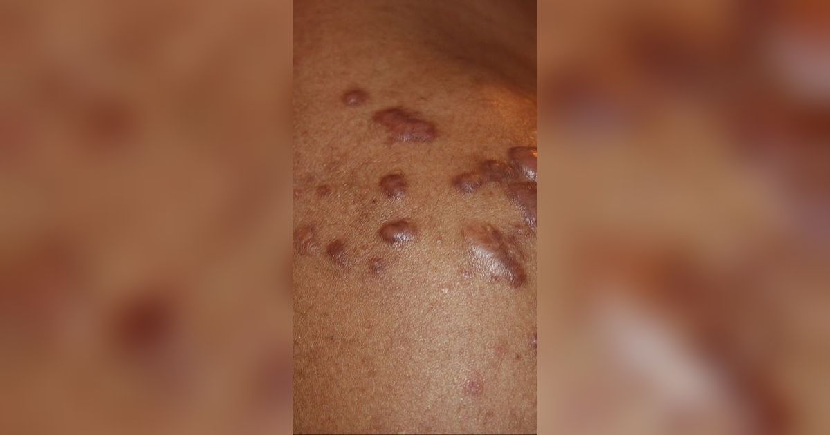 9 Cara Mudah dan Sederhana Obati Keloid di Rumah secara Mandiri