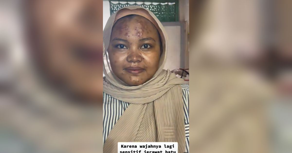 Gak Pede karena Wajah Penuh Jerawat Batu, MUA Ini Rias Pengantin sampai Jadi Halus Banget
