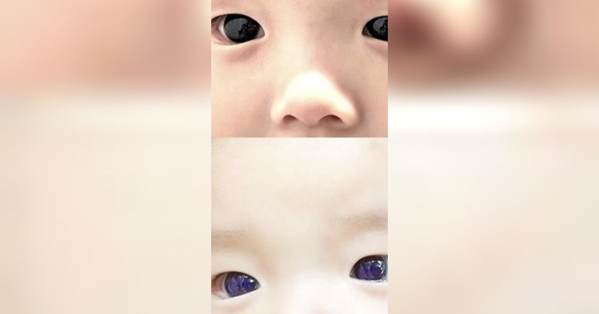 Thai Baby's Eyes Turned Blue Just One Night After Covid19 Treatment