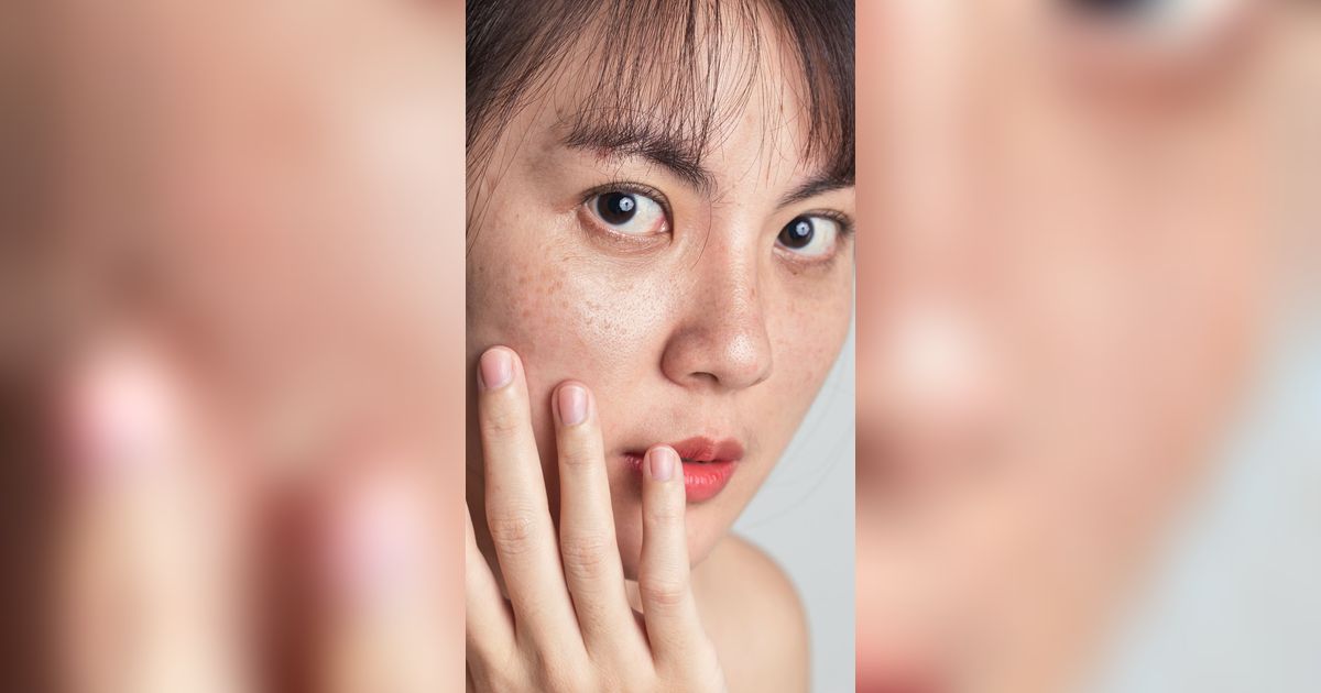 Jerawat Remaja Tak Boleh Disepelekan, Rawat Biar Tak Jadi Bopeng