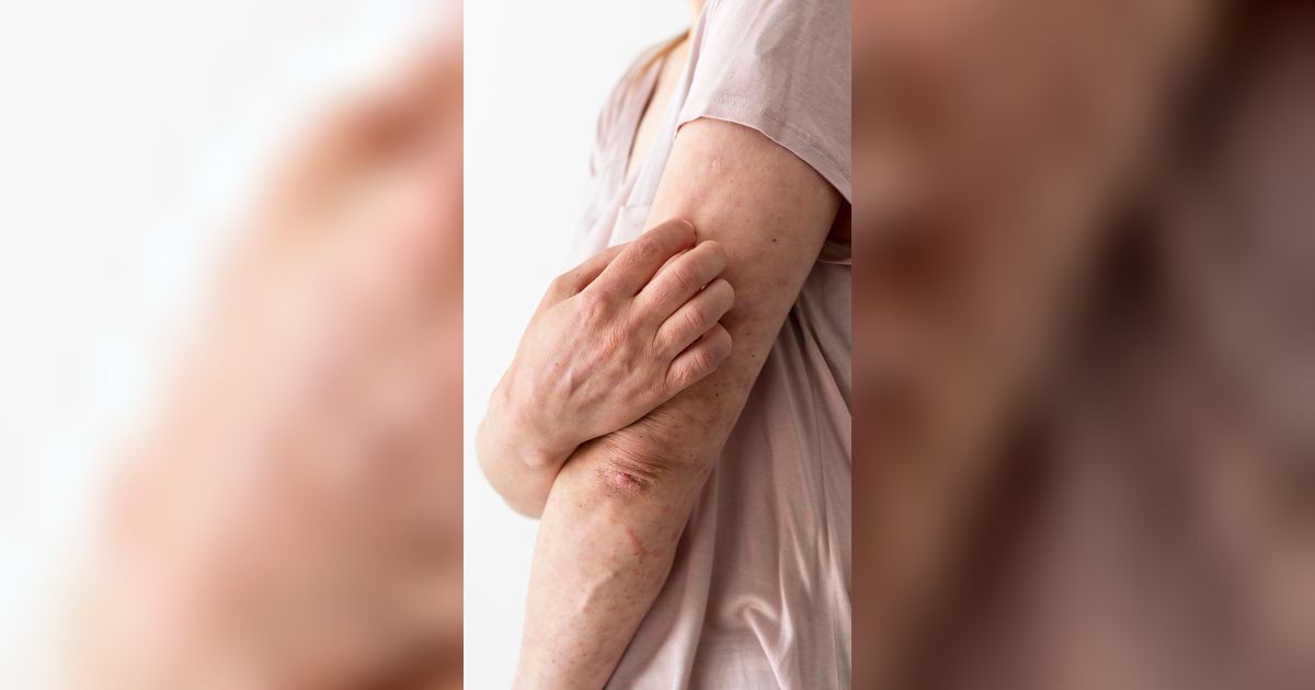 Doa ketika Terkena Penyakit Gatal serta Cara Mengatasinya agar Tidak Semakin Parah