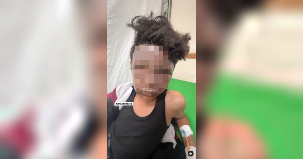 Kisah Pilu Bocah Gaza Korban Bom Israel: Aku Menangis Setiap Lihat Wajahku Sendiri