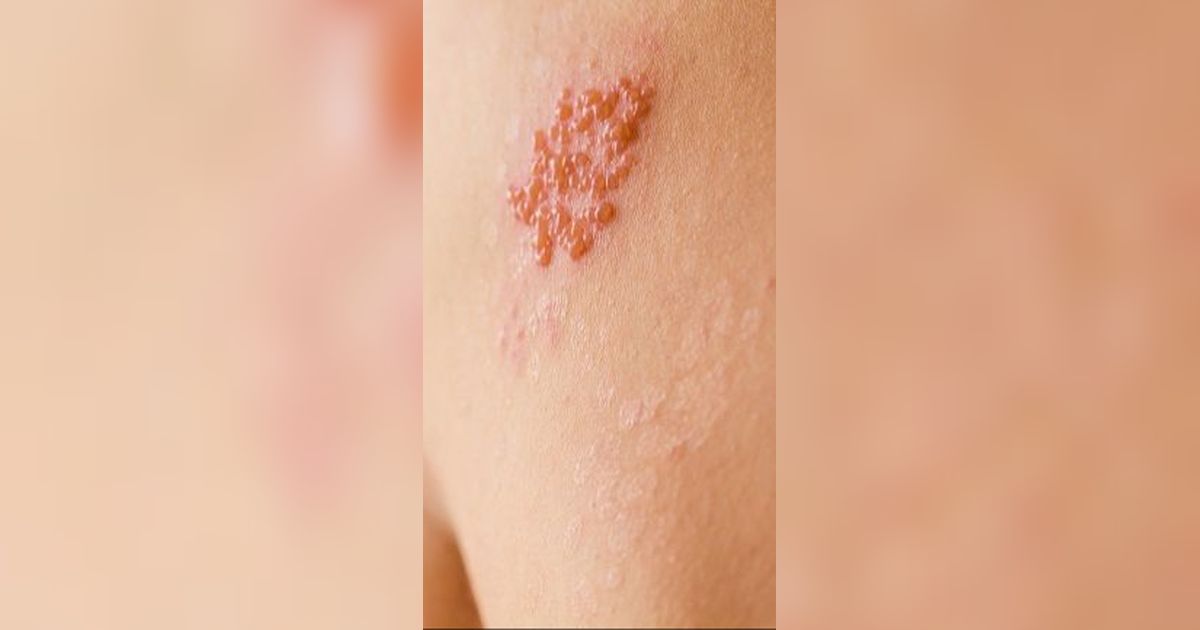 Mitos Dompo Alias Herpes Zoster yang Harus Diketahui, Simak Penyebabnya