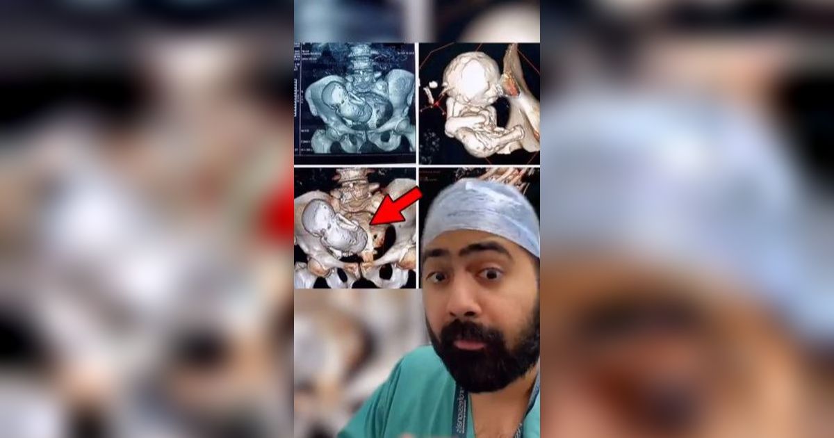 Nenek 73 Tahun Ngeluh Sakit Perut, Setelah Dicek Ternyata Ada Janin Berusia 35 Tahun di Dalam Perut, Sudah Jadi Batu