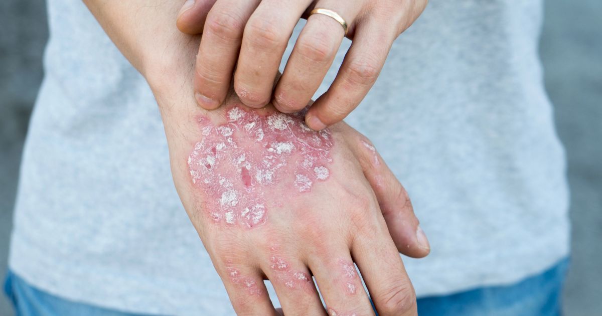 Inovasi Klinik Kecantikan Hadirkan Treatment Psoriasis untuk Keluarga, Cek Fakta Penyakit Ini Yuk!