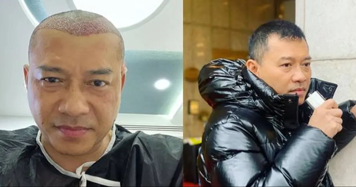 Ramai Artis Transplantasi Rambut, Inget Loh Ini yang Terjadi saat Pemulihan